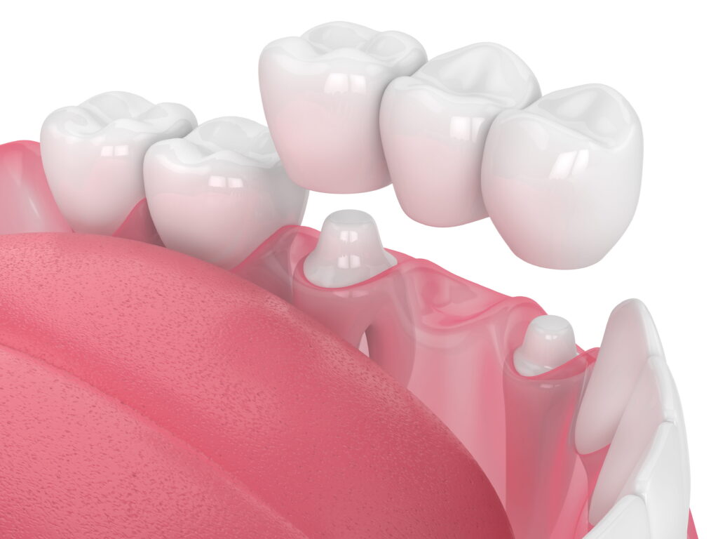 Dental Bridges at Oakwood Dental and Implants